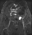 Adnexal multilocular cyst (O-RADS US 3- O-RADS MRI 3) (Radiopaedia 87426-103754 Coronal T2 fat sat 7).jpg