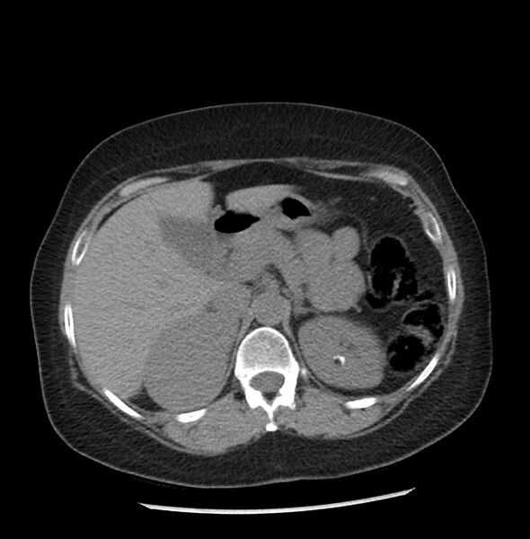 File:Adrenal cortical carcinoma with IVC invasion and thrombosis (Radiopaedia 34307-35597 Axial non-contrast 15).jpg