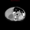 Adrenal hemorrhage (Radiopaedia 9390-10077 Axial C+ portal venous phase 11).jpg