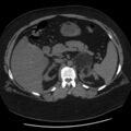Adrenal myelolipoma (Radiopaedia 8216-9068 Axial non-contrast 17).jpg