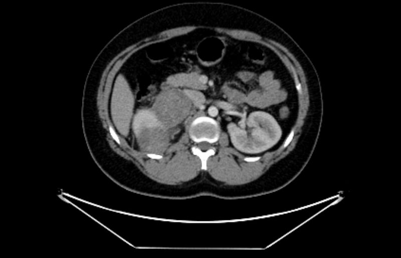 File:Adrenocortical carcinoma (Radiopaedia 80134-93438 Axial C+ portal venous phase 53).jpg