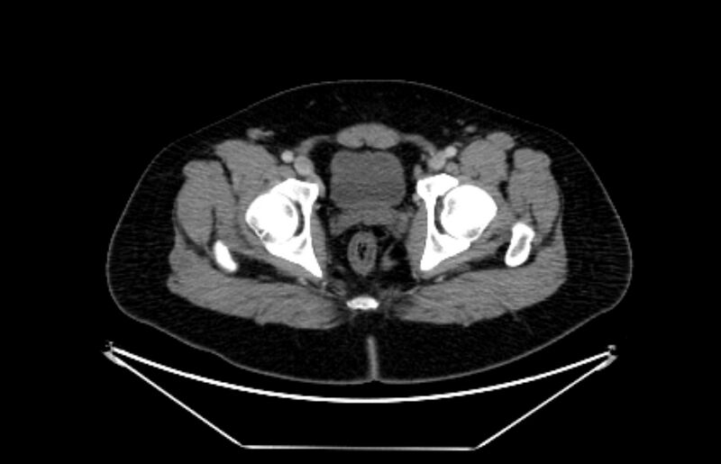 File:Adrenocortical carcinoma (Radiopaedia 80134-93438 Coronal C+ portal venous phase 10).jpg