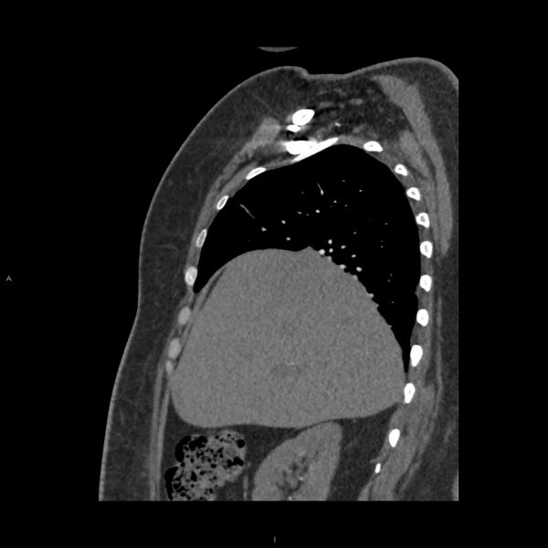 File:Agenesis of the left hepatic lobe (Radiopaedia 77284-89359 Sagittal C+ CTPA 29).jpg