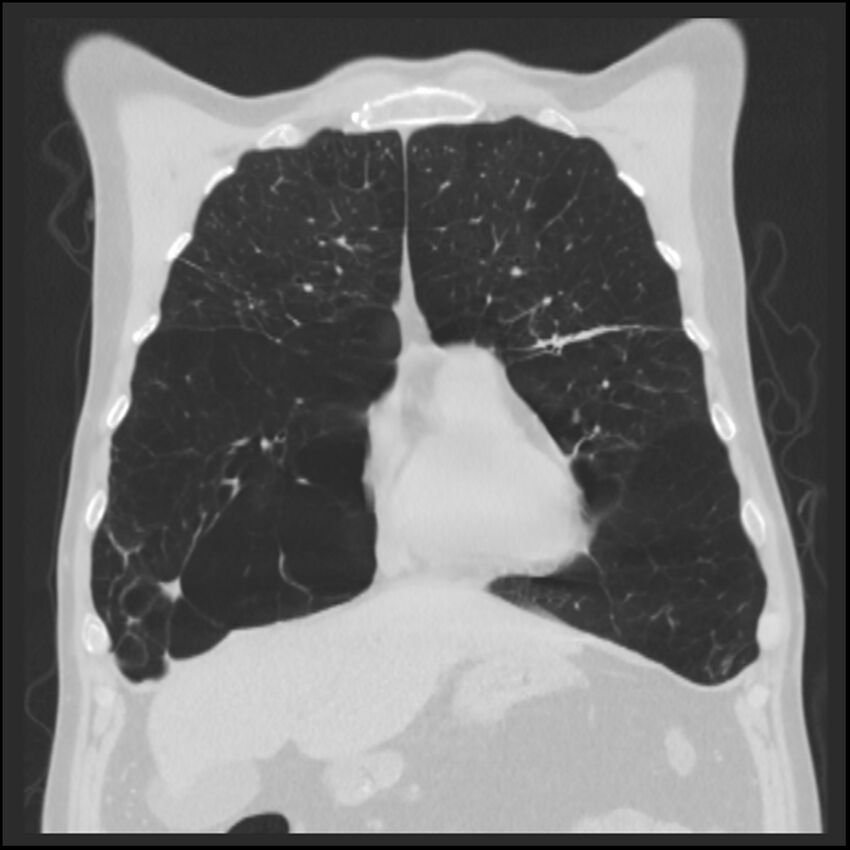 Alpha-1-antitrypsin deficiency (Radiopaedia 40993-43722 Coronal lung window 26).jpg