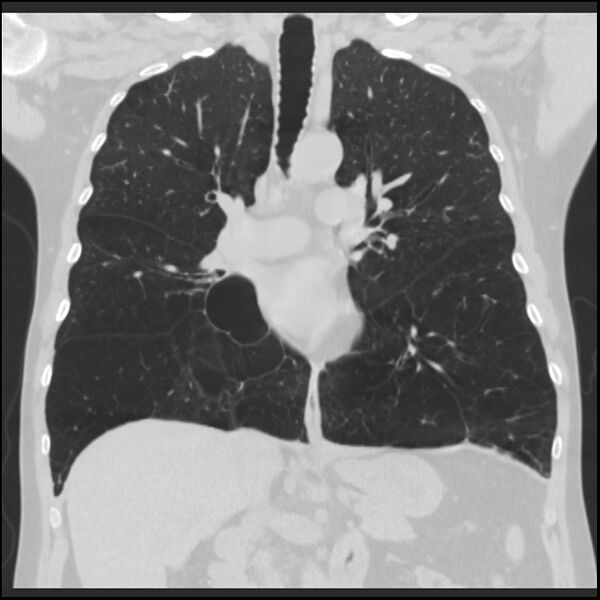 File:Alpha-1-antitrypsin deficiency (Radiopaedia 40993-43722 Coronal lung window 49).jpg