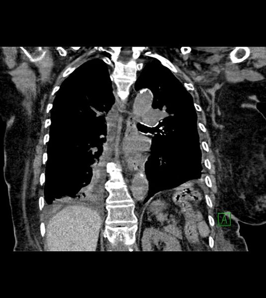 File:Amiodarone deposition in the liver (Radiopaedia 77587-89780 Coronal non-contrast 50).jpg