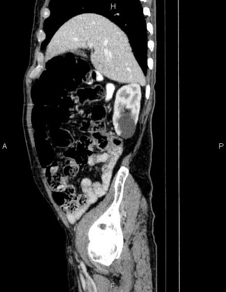 File:Ampullary adenocarcinoma (Radiopaedia 86093-102032 D 22).jpg