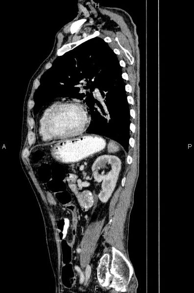 File:Ampullary adenocarcinoma (Radiopaedia 86093-102033 E 64).jpg