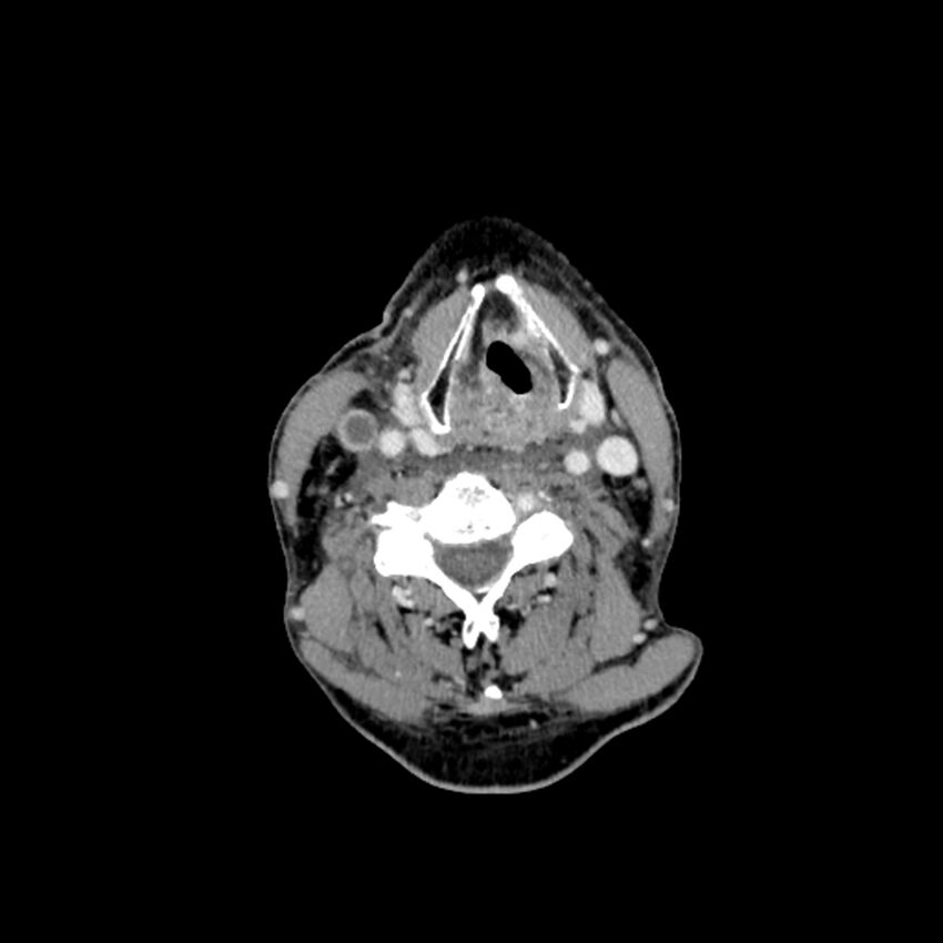 Anaplastic thyroid carcinoma (Radiopaedia 79087-92034 B 62).jpg