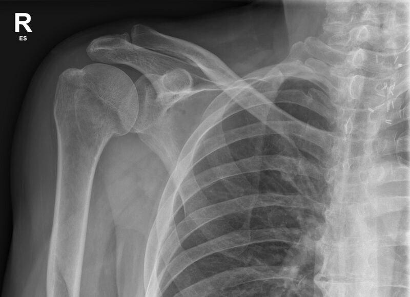 File:Anatomical neck of humerus fracture (Radiopaedia 66621-75918 Frontal 1).jpg