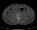 Aneurysmal bone cyst of ischium (Radiopaedia 25957-26094 Axial bone window 2).png