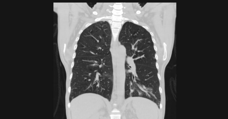 File:Angioinvasive aspergellosis (Radiopaedia 66995-76315 Coronal lung window 40).jpg
