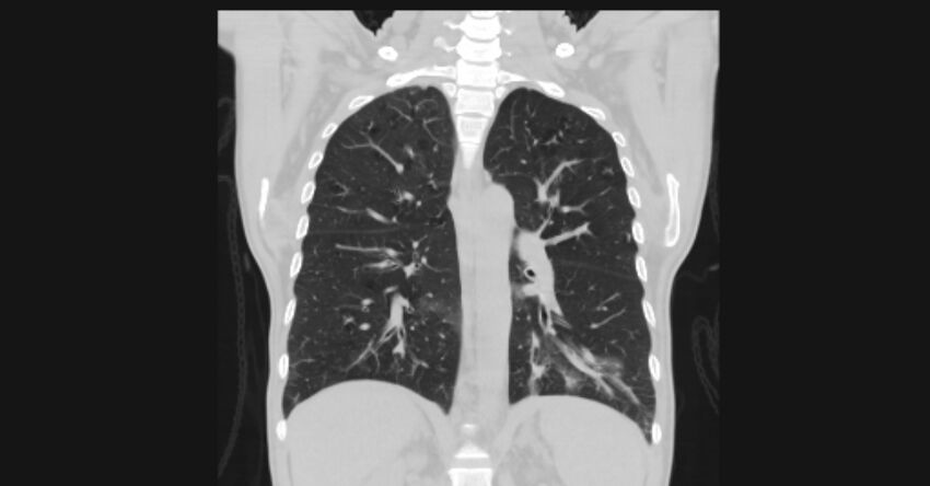 Angioinvasive aspergellosis (Radiopaedia 66995-76315 Coronal lung window 40).jpg