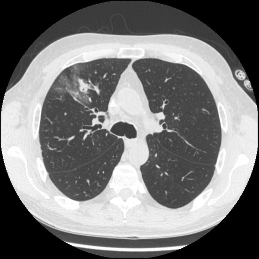 Angioinvasive aspergillosis (Radiopaedia 43957-47466 Axial lung window 25).jpg