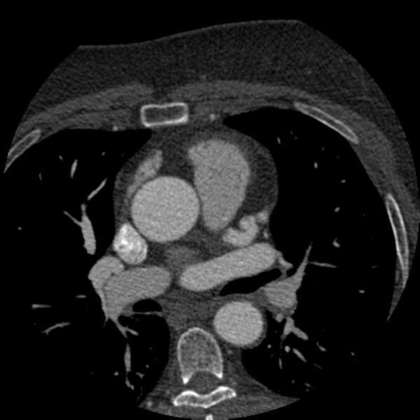 File:Anomalous origin of left circumflex artery from right coronary sinus (Radiopaedia 72563-83117 B 24).jpg