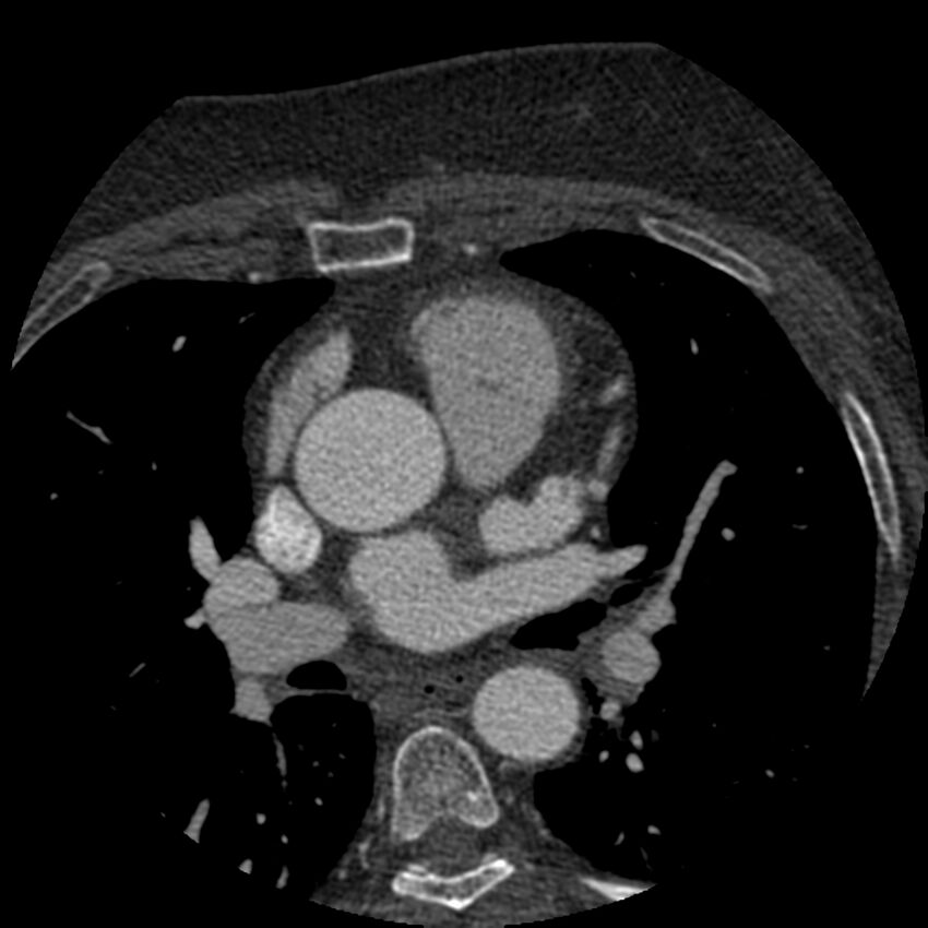 Anomalous origin of left circumflex artery from right coronary sinus (Radiopaedia 72563-83117 B 29).jpg