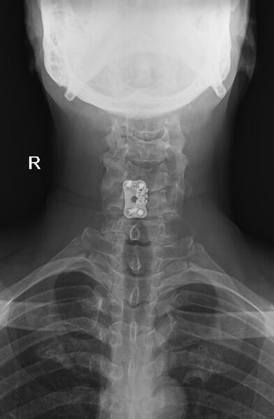 File:Anterior cervical discectomy and fusion (ACDF) (Radiopaedia 70491-80610 Frontal 1).jpg