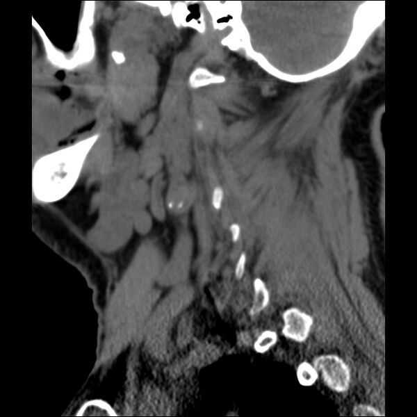 File:Anterior cervical postdiscectomy arthrodesis (Radiopaedia 32678-33646 C 37).jpg