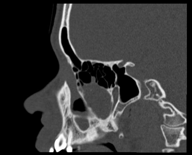 File:Antrochoanal polyp (Radiopaedia 21894-21868 Sagittal bone window 14).jpg