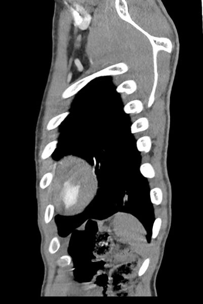 File:Aortic coarctation with aneurysm (Radiopaedia 74818-85828 B 140).jpg