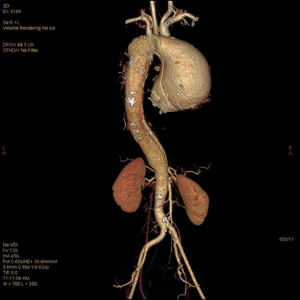 File:Aortic dissection (Radiopaedia 25350-25604 E 11).jpg