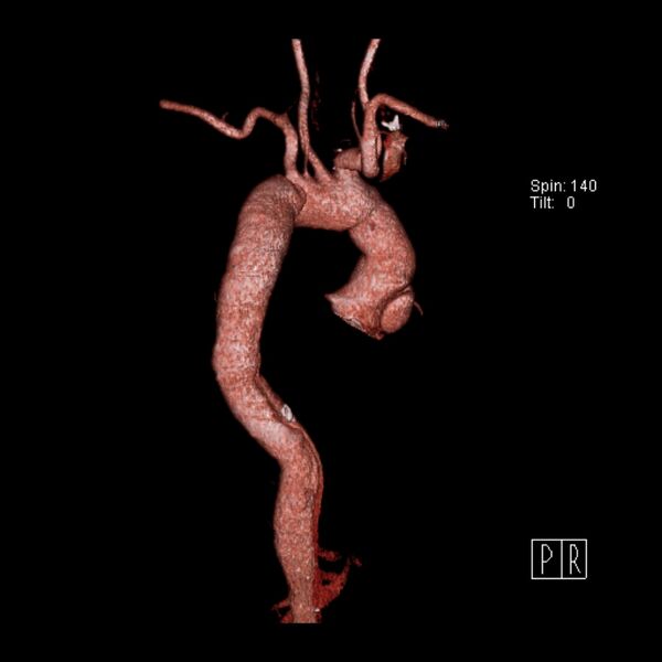 File:Aortic dissection - De Bakey type III - Stanford B (Radiopaedia 21903-21882 3D C+ arterial phase 8).jpg