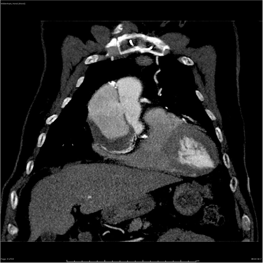 Aortic dissection - Stanford type A (Radiopaedia 26183-26315 A 9).jpg