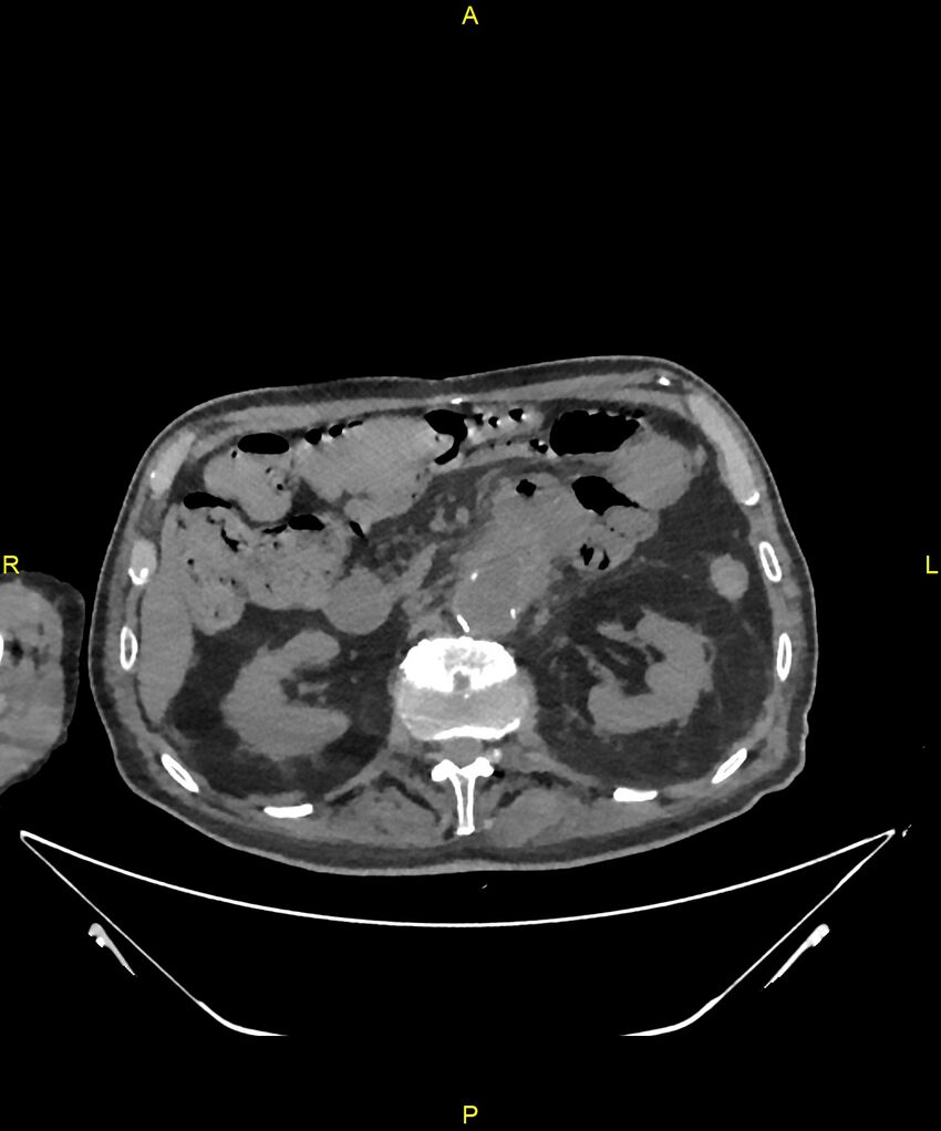 Aortoenteric fistula (Radiopaedia 84308-99603 Axial non-contrast 121).jpg