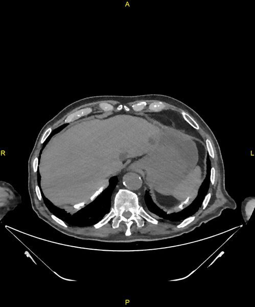 File:Aortoenteric fistula (Radiopaedia 84308-99603 Axial non-contrast 34).jpg