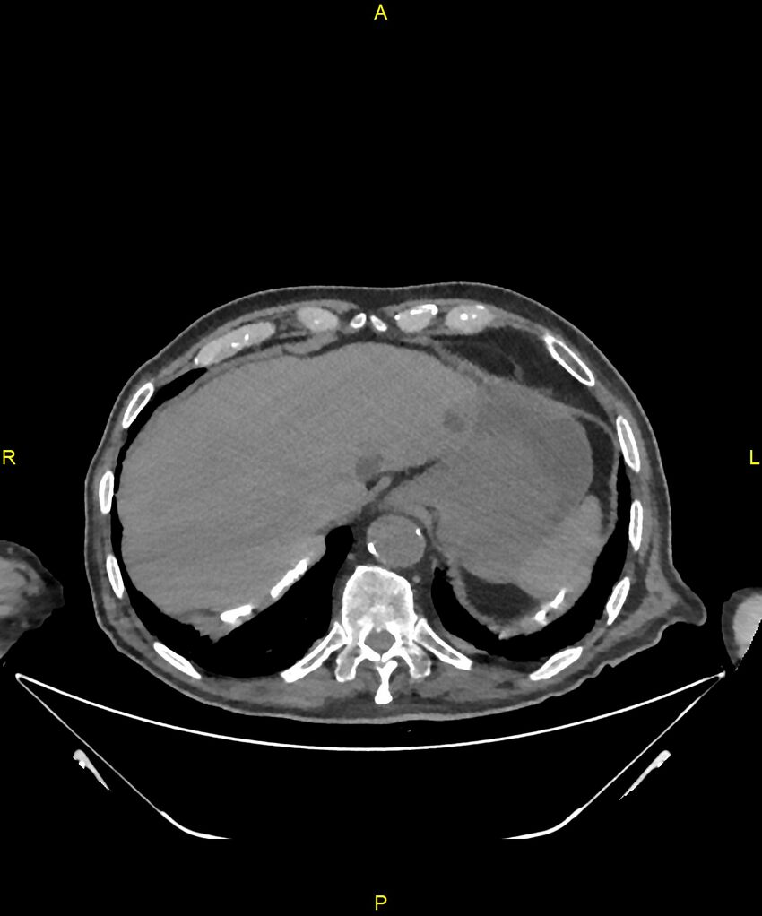 Aortoenteric fistula (Radiopaedia 84308-99603 Axial non-contrast 34).jpg