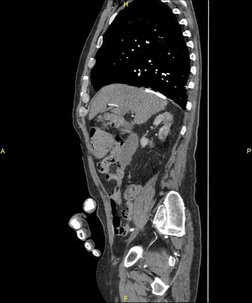 File:Aortoenteric fistula (Radiopaedia 84308-99603 C 115).jpg