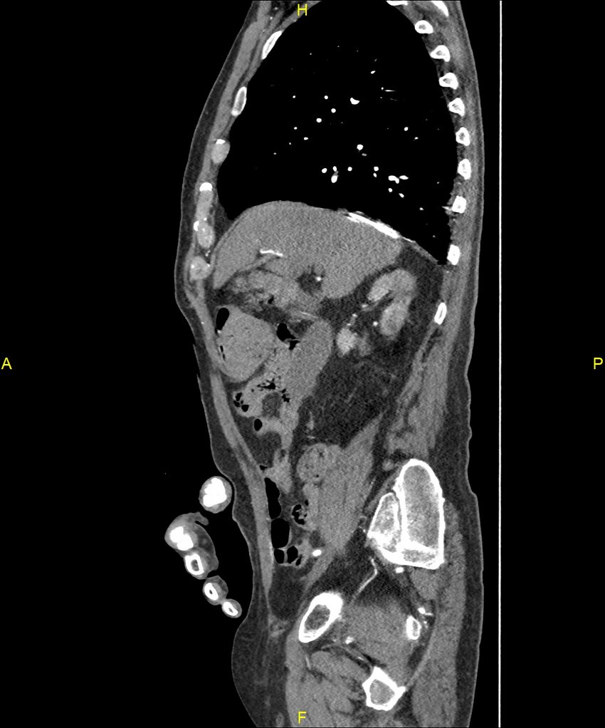 Aortoenteric fistula (Radiopaedia 84308-99603 C 115).jpg