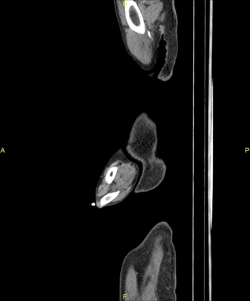 Aortoenteric fistula (Radiopaedia 84308-99603 C 2).jpg