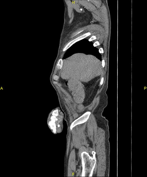File:Aortoenteric fistula (Radiopaedia 84308-99603 C 43).jpg