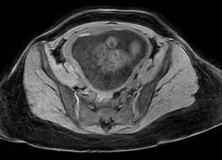 Appendicitis in gravida (MRI) (Radiopaedia 89433-106395 Axial DIXON 116).jpg