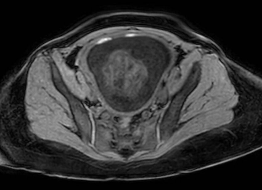 Appendicitis in gravida (MRI) (Radiopaedia 89433-106395 Axial DIXON 120).jpg