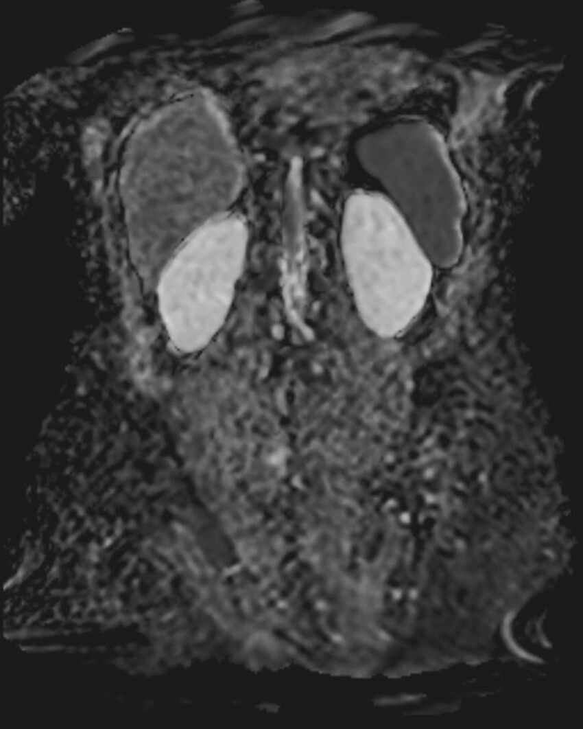 Appendicitis in gravida (MRI) (Radiopaedia 89433-106395 Coronal ADC 46).jpg