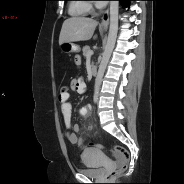 File:Appendicitis with microperforation- promontoric type (Radiopaedia 27268-27442 A 25).jpg