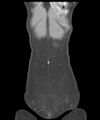 Appendicitis with minimal stranding but appendicolith (Radiopaedia 29035-29397 B 7).jpg
