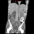 Appendicitis with phlegmon (Radiopaedia 9358-10046 B 38).jpg