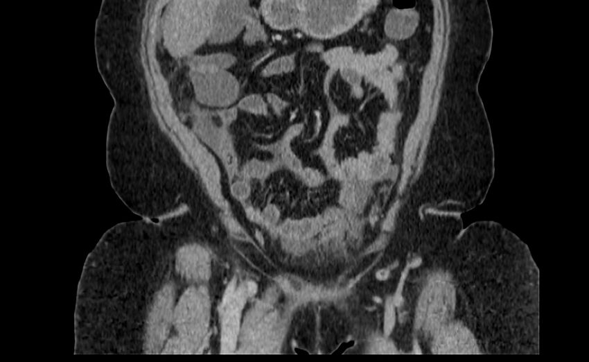 Appendix mucocele (Radiopaedia 41222-44033 B 13).jpg