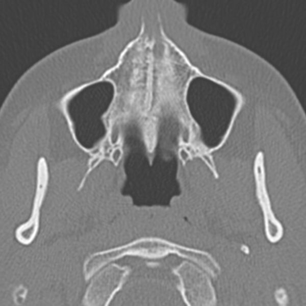 File:Arrested pneumatization of the sphenoid (Radiopaedia 10700-11172 Axial non-contrast 19).jpg