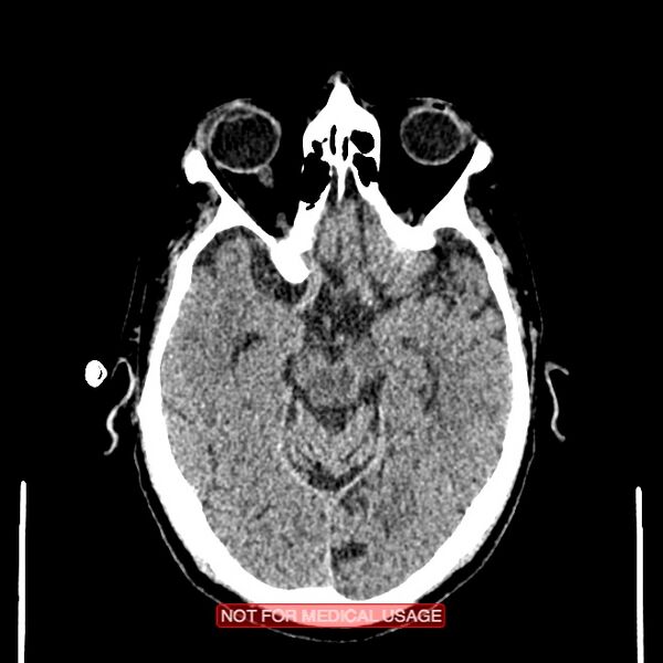 File:Artery of Percheron infarction (Radiopaedia 28679-28967 Axial non-contrast 46).jpg
