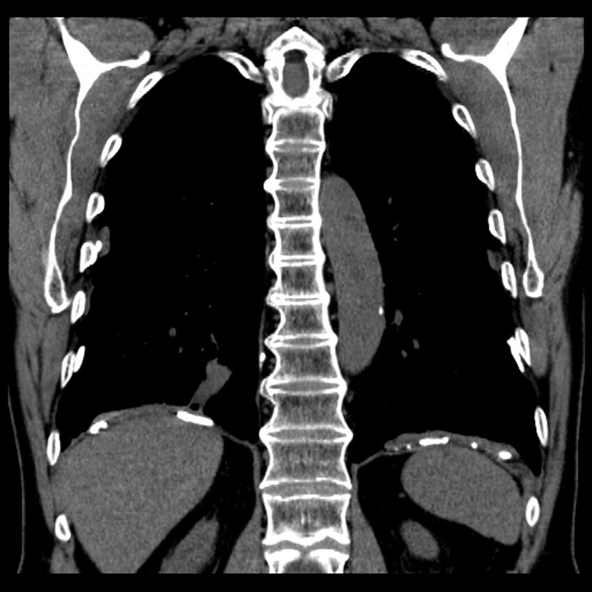 Asbestos-related pleural plaques (Radiopaedia 39069-41255 Coronal non-contrast 24).jpg
