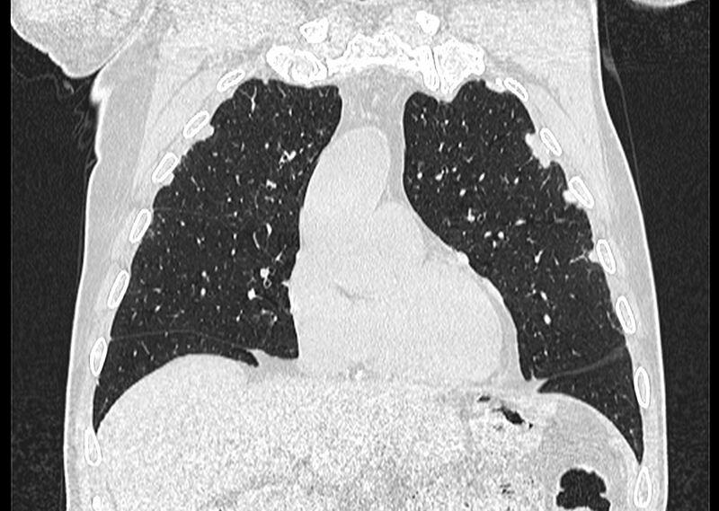 File:Asbestos pleural placques (Radiopaedia 57905-64872 Coronal lung window 88).jpg