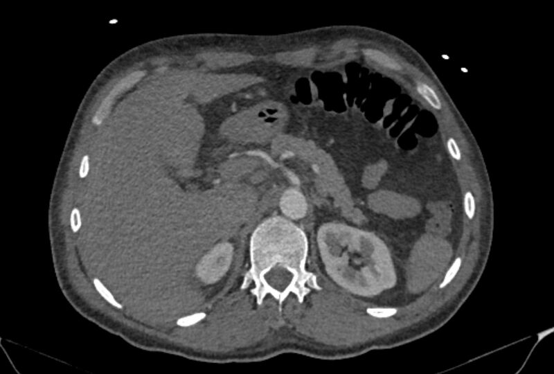 File:Ascending aortic aneurysm (Radiopaedia 86279-102297 C 71).jpg