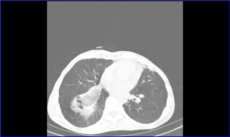 File:Aspergilloma (Radiopaedia 20788-20701 Axial lung window 22).jpg