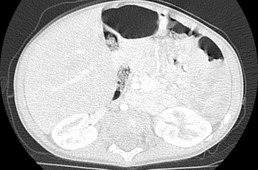 Asplenia syndrome (Radiopaedia 73083-83792 Axial lung window 91).jpg