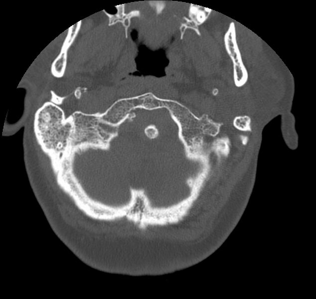 File:Atlanto-occipital assimilation with basilar invagination (Radiopaedia 70122-80188 Axial bone window 11).jpg