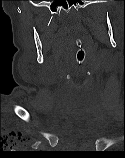 File:Atlanto-occipital dissociation - Traynelis type 1 (Radiopaedia 87570-103948 Coronal bone window 11).jpg